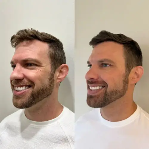 Side-by-side before and after photos of a male client following Botox treatment at Pure Seoul Aesthetics in West Bloomfield, Michigan.